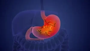 كيف تخرج جرثومة المعدة من الجسم
