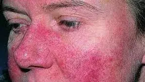 مرض الذئبة الحمراء